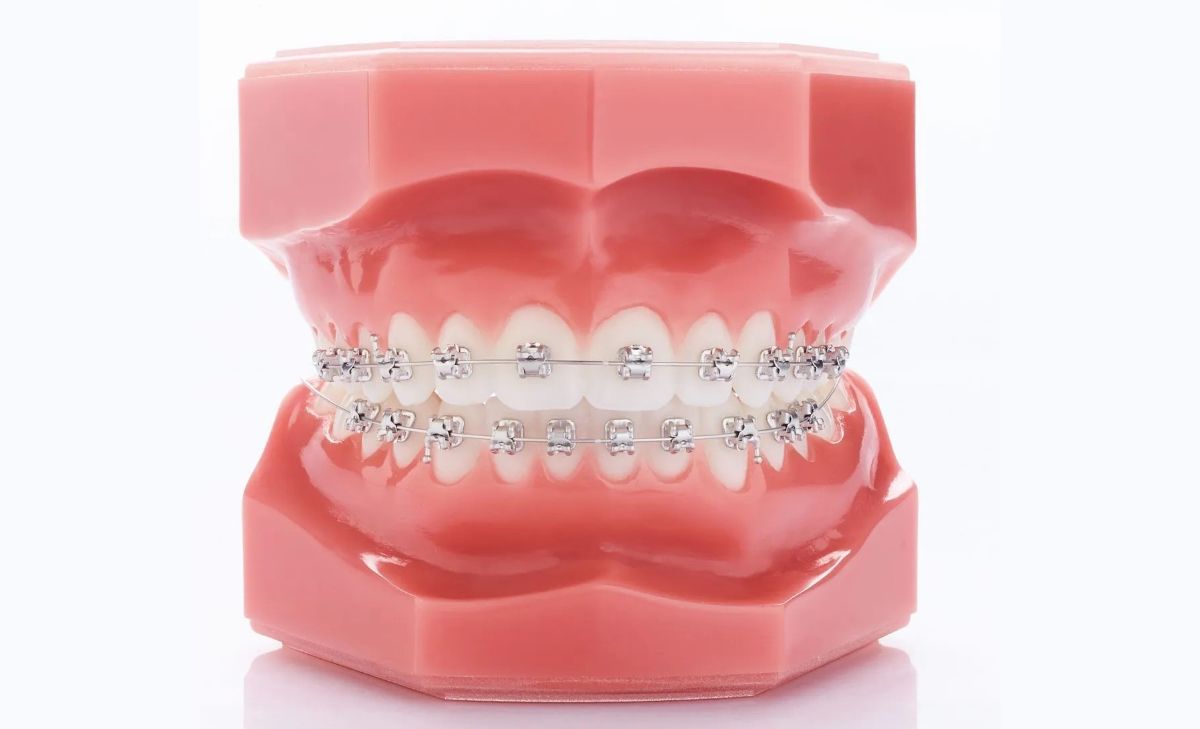 niềng răng mắc cài tự buộc